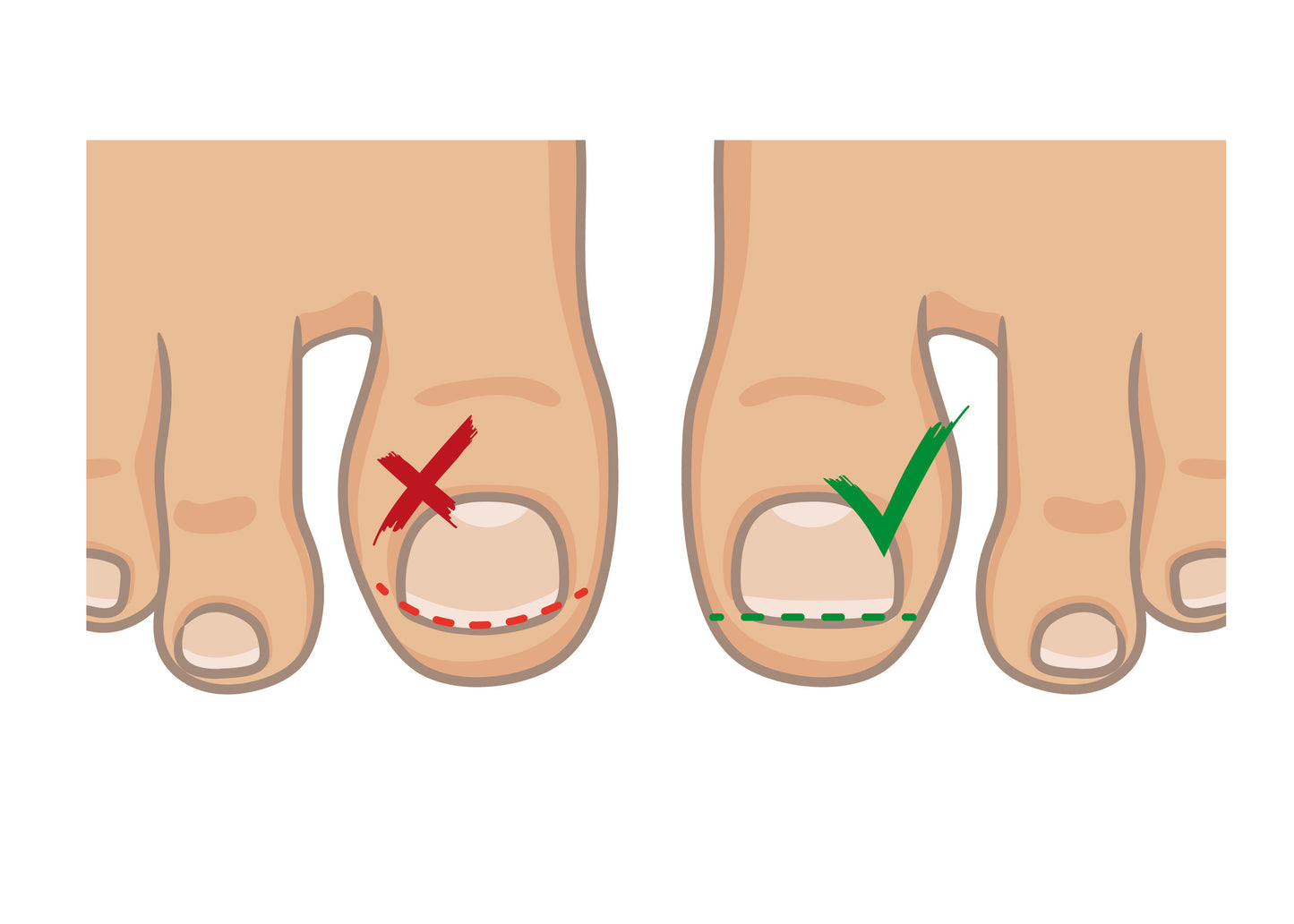 Lime pour ongles incarnés